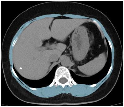 Skeletal muscle index based on CT at the 12th thoracic spine level can predict osteoporosis and fracture risk: a propensity score-matched cohort study